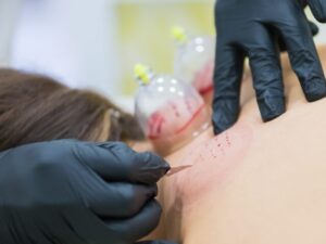 吸い玉（カッピング）の“あざ”って効果あるの？～スポーツを頑張る子どもの体に、本当に必要かを考える～