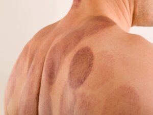 吸い玉（カッピング）の“あざ”って効果あるの？～スポーツを頑張る子どもの体に、本当に必要かを考える～