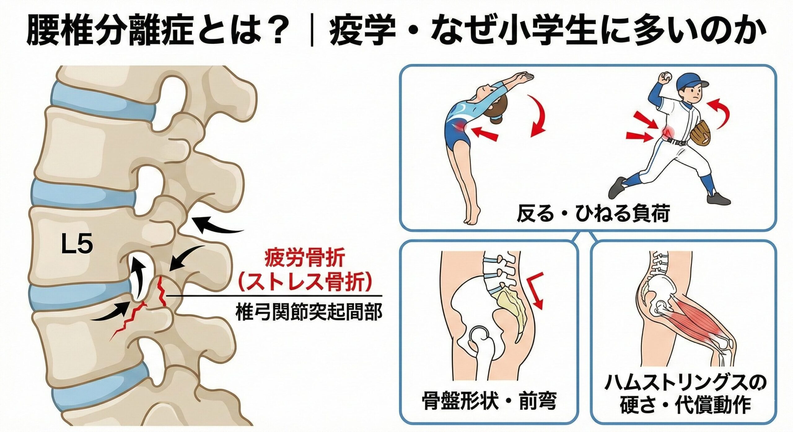 小学生の腰椎分離症|最新エビデンスで変わる「治し方・戻し方」完全ガイド