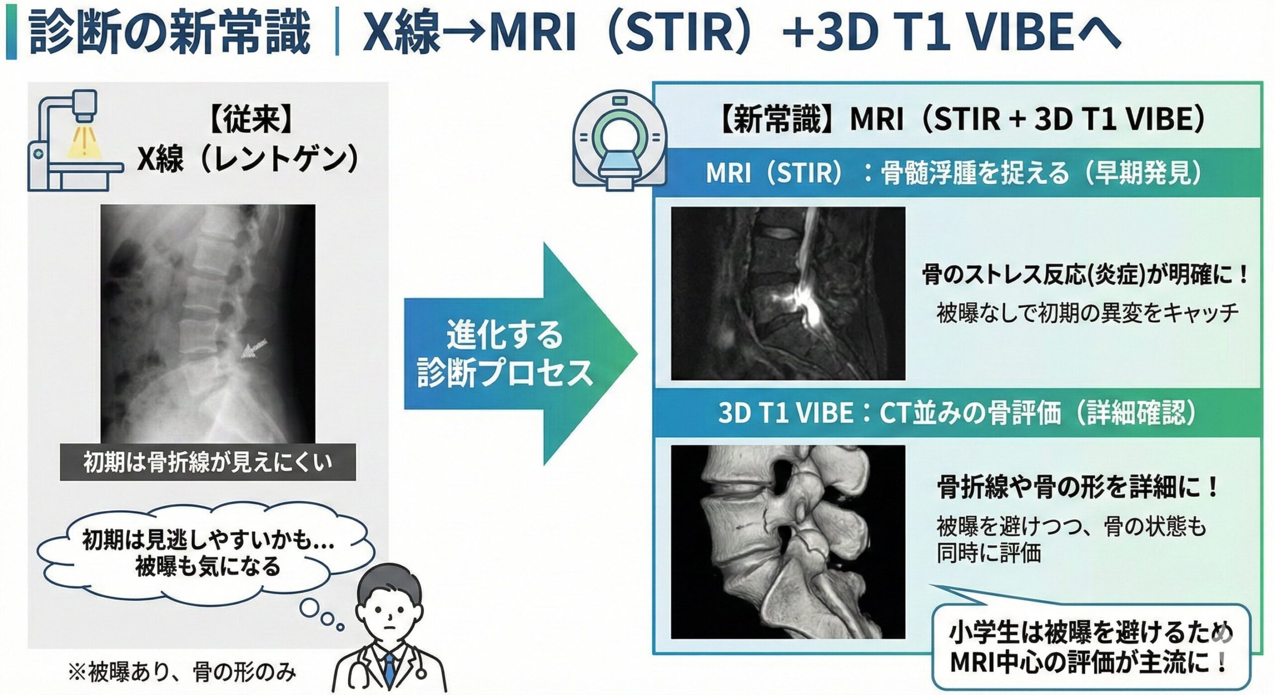 小学生の腰椎分離症|最新エビデンスで変わる「治し方・戻し方」完全ガイド